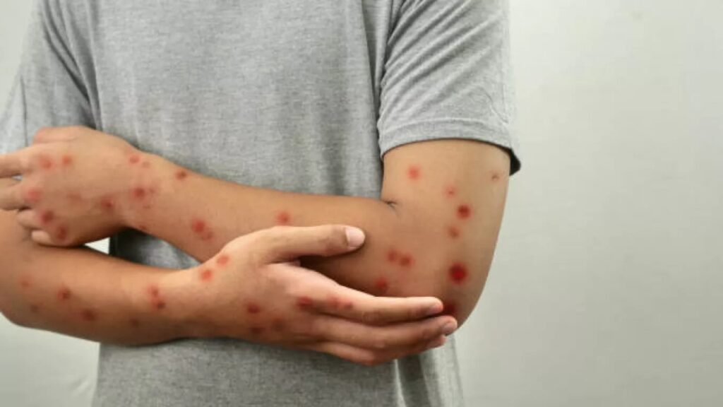 Detectan en Alemania nueva variante de la viruela del mono